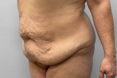 Before image 2 Case #123221 - Tummy Tuck