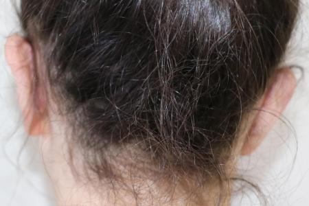 After image 2 Case #123061 - Transhelical Scar Less Otoplasty