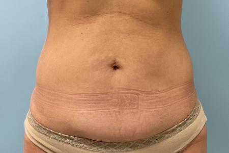 Before image 1 Case #123391 - 47 year old female with Mini Abdominoplasty