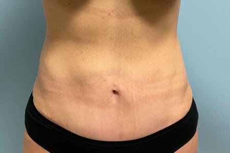 After image 1 Case #123391 - 47 year old female with Mini Abdominoplasty