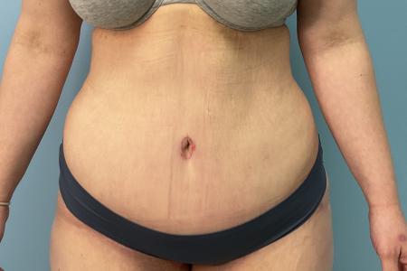 After image 1 Case #123456 - 34 year old female with an abdominoplasty