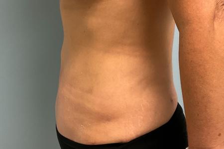 After image 2 Case #123391 - 47 year old female with Mini Abdominoplasty