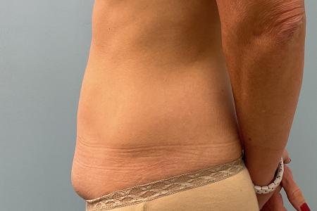 Before image 2 Case #123391 - 47 year old female with Mini Abdominoplasty