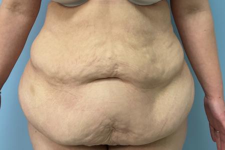 Before image 1 Case #123456 - 34 year old female with an abdominoplasty