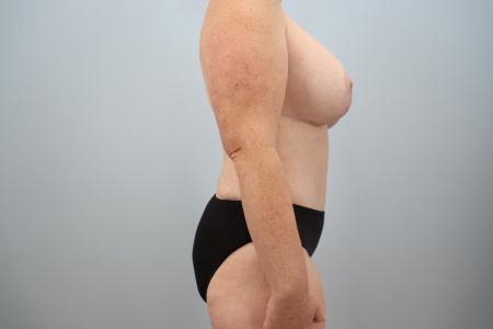 After image 2 Case #123916 - Mommy Makeover