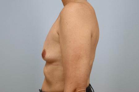 Before image 2 Case #123921 - Breast Augmentation