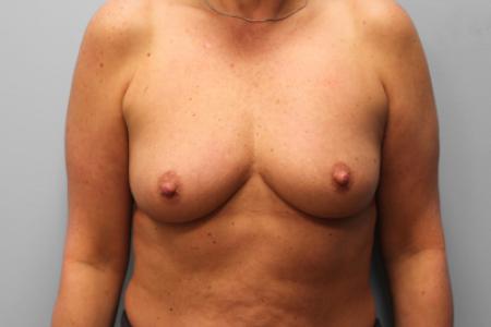 Before image 1 Case #123676 - Breast Augmentation