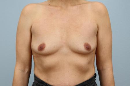 Before image 1 Case #123921 - Breast Augmentation