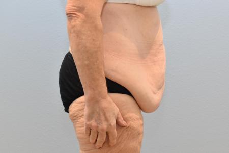 Before image 2 Case #124041 - Tummy Tuck