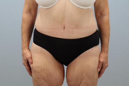 After image 1 Case #124041 - Tummy Tuck