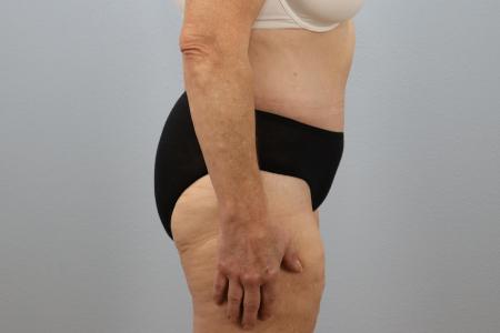 After image 2 Case #124041 - Tummy Tuck