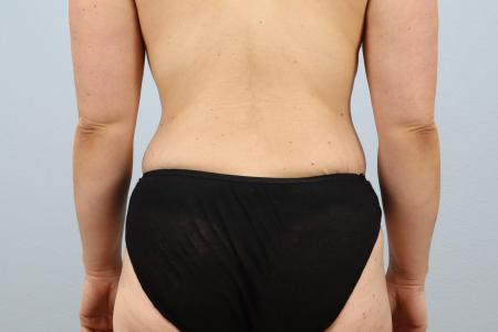 After image 3 Case #124426 - Tummy Tuck