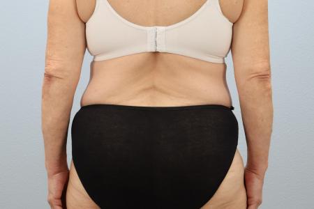 After image 3 Case #124041 - Tummy Tuck