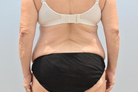 Before image 3 Case #124041 - Tummy Tuck