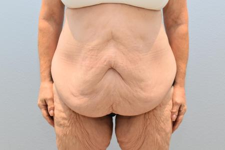 Before image 1 Case #124041 - Tummy Tuck