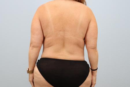 After image 3 Case #124816 - Mommy Makeover