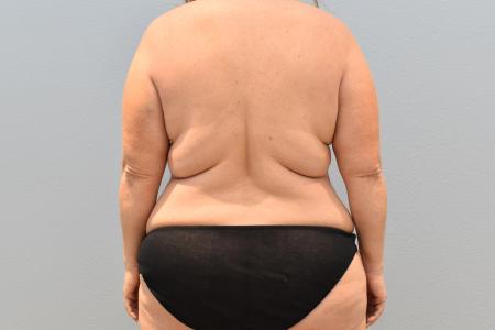 Before image 3 Case #124816 - Mommy Makeover