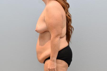 Before image 2 Case #124816 - Mommy Makeover