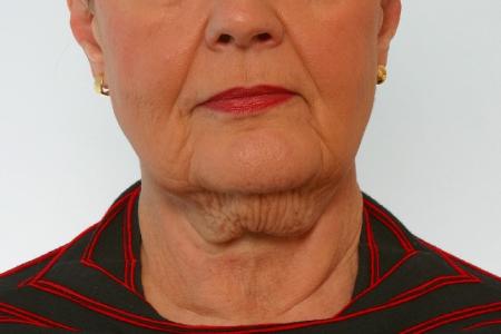 Before image 1 Case #125916 - Neck Lift