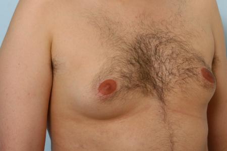 Before image 2 Case #125996 - Gynecomastia