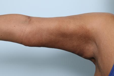 After image 1 Case #125941 - Arm Lift