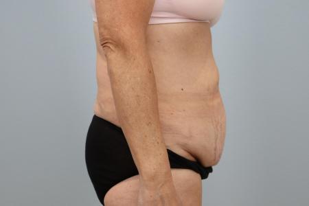 Before image 2 Case #125556 - Tummy Tuck & Liposuction Results | Dr. Neaman