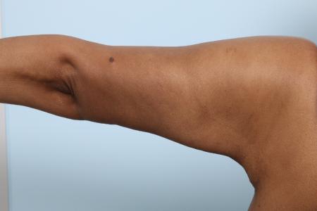 After image 2 Case #125941 - Arm Lift