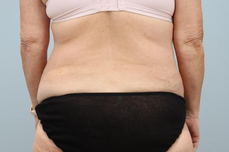 Before image 3 Case #125556 - Tummy Tuck & Liposuction Results | Dr. Neaman