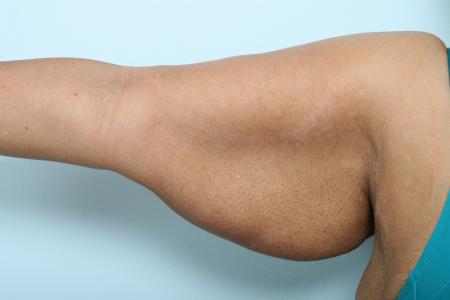 Before image 1 Case #125941 - Arm Lift