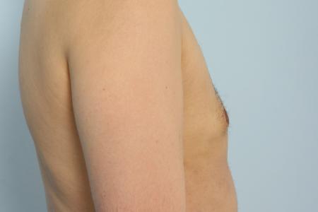 After image 3 Case #125996 - Gynecomastia