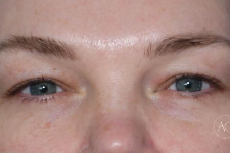 Before image 1 Case #125786 -  Upper blepharoplasty