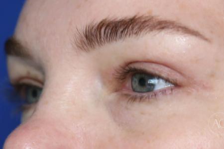 After image 2 Case #125786 -  Upper blepharoplasty