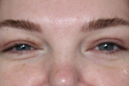 After image 1 Case #125786 -  Upper blepharoplasty