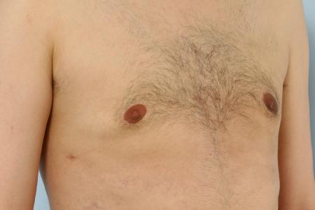 After image 2 Case #125996 - Gynecomastia