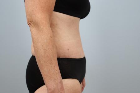 After image 2 Case #125556 - Tummy Tuck & Liposuction Results | Dr. Neaman