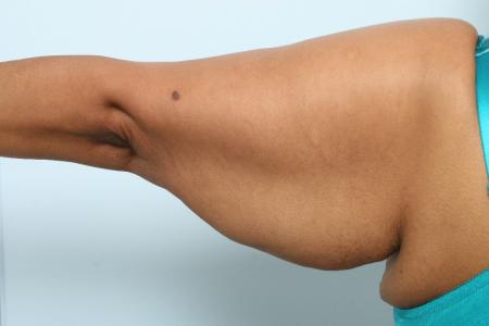 Before image 2 Case #125941 - Arm Lift