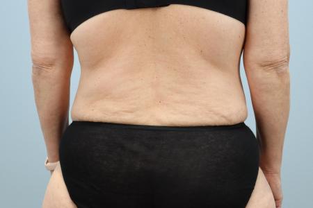 After image 3 Case #125556 - Tummy Tuck & Liposuction Results | Dr. Neaman