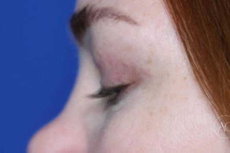 After image 3 Case #125786 -  Upper blepharoplasty