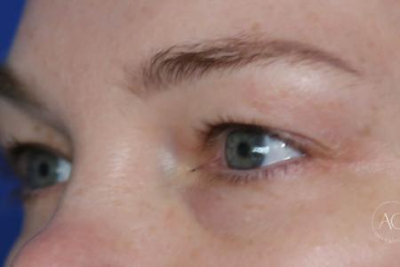 Before image 2 Case #125786 -  Upper blepharoplasty