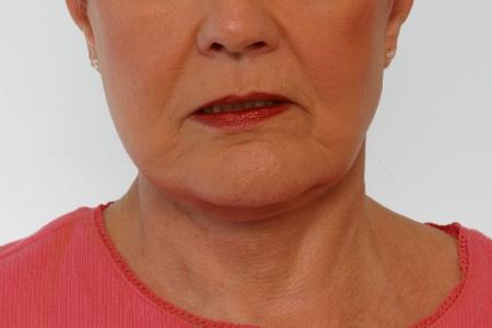 After image 1 Case #125916 - Neck Lift