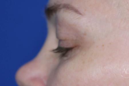 Before image 3 Case #125786 -  Upper blepharoplasty