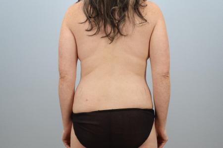 Before image 3 Case #126171 - Mommy Makeover by Dr. Neaman | Salem, OR