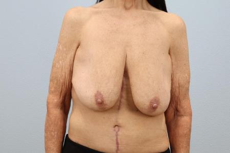 Before image 1 Case #126716 - Breast Reduction for 63-Year-Old | Dr. Neaman