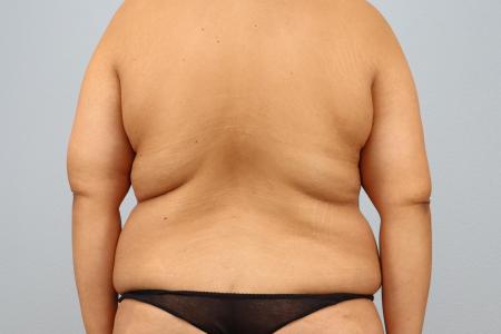 Before image 3 Case #126181 - Tummy Tuck and Bra Line Back Lift Results by Dr. N