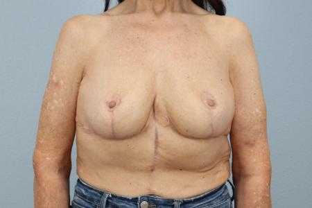 After image 1 Case #126716 - Breast Reduction for 63-Year-Old | Dr. Neaman