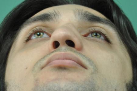 Before image 6 Case #122526 - Aesthetic Reduction Rhinoseptoplasty