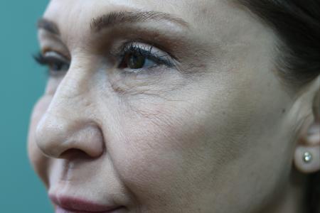 Before image 5 Case #122891 - Upper Lid Open Sky Blepharoplasty, Midface Lifting