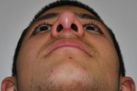 After image 6 Case #126761 - Primary Rhinoplasty