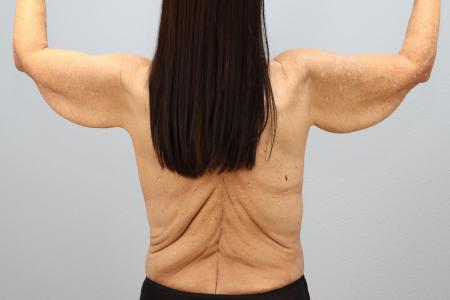 Before image 2 Case #126721 - Arm Lift Surgery | Results by Dr. Neaman