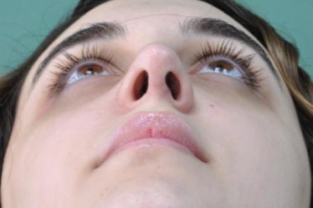 After image 6 Case #122886 - Functional Aesthetic Septorhinoplasty